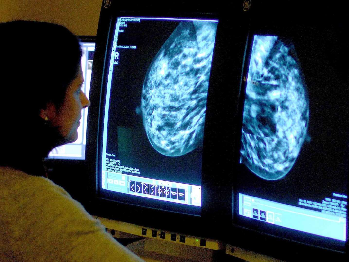 About one in eight women are diagnosed with breast cancer during their lifetime, according to the NHS (Rui Vieira/PA)