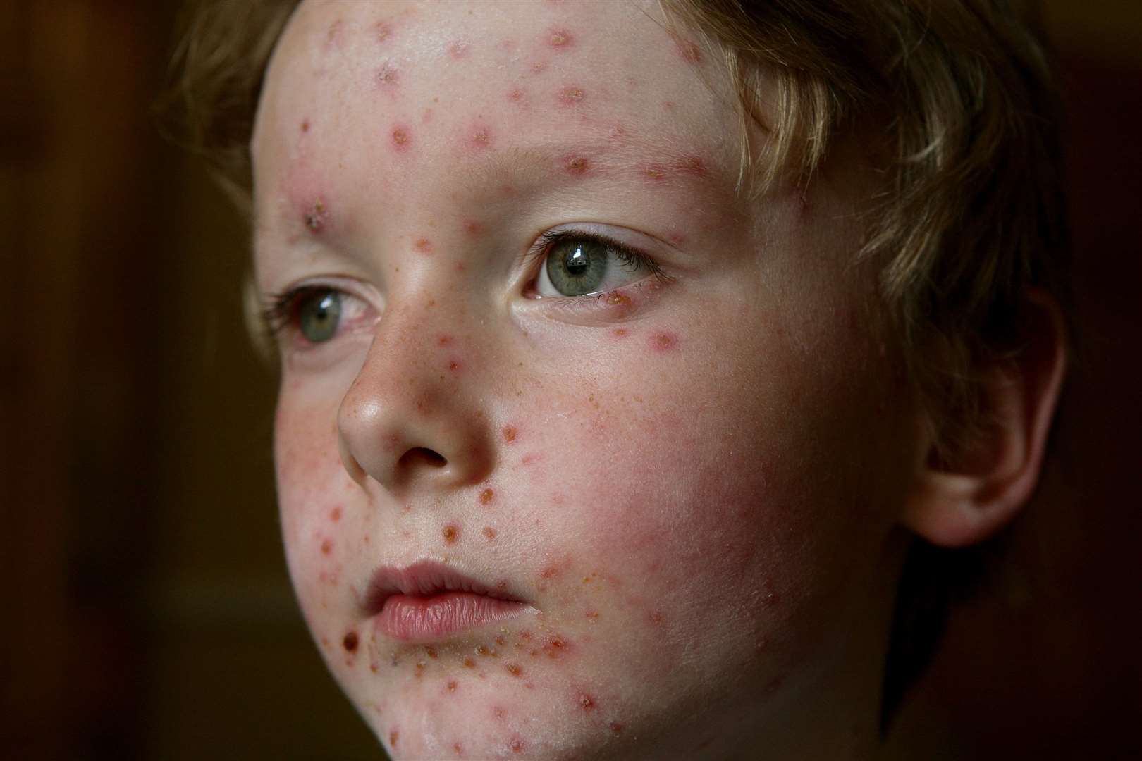 According to the NHS, nine out of ten adults carry the virus that causes shingles after having had chicken pox in childhood (Dave Thompson/PA)