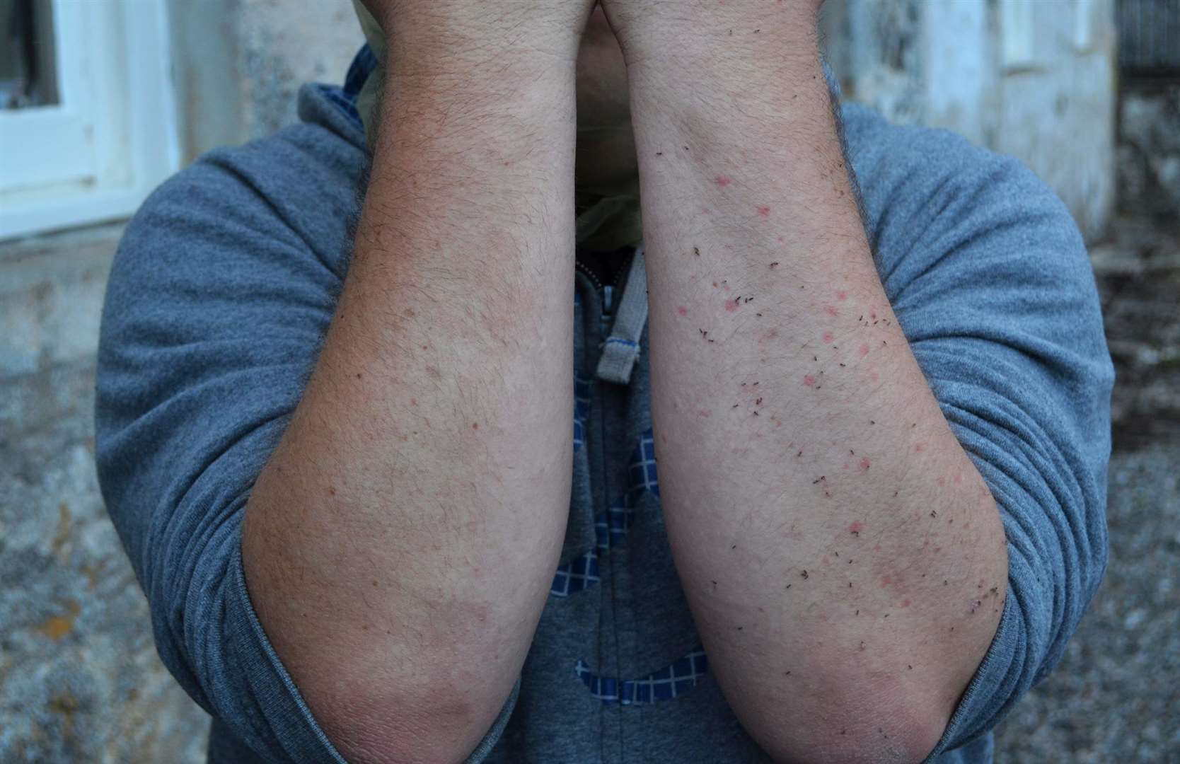 Insect bites can be a serious problem for some people.