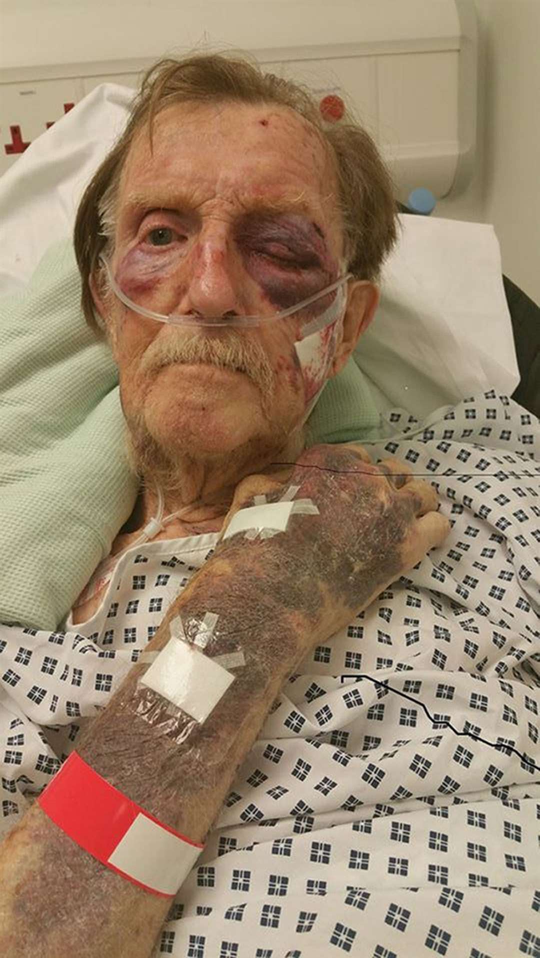 Pictures of Arthur Gumbley’s injuries were released in 2017 as part of appeals to catch his attackers (Staffordshire Police/PA)